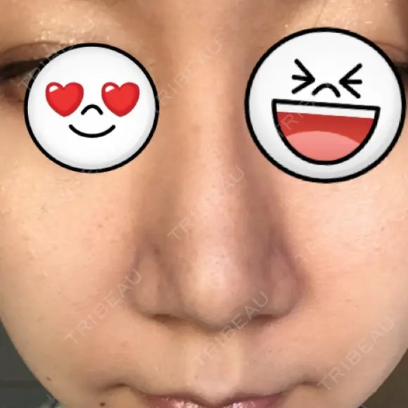 鼻尖形成（切開） / ヒアルロン酸注入（鼻） 東京ヒルズクリニック 新宿院 DAY 38 メイン用