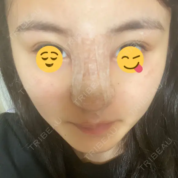 隆鼻術 湘南美容クリニック 岡山院 DAY 0 メイン用