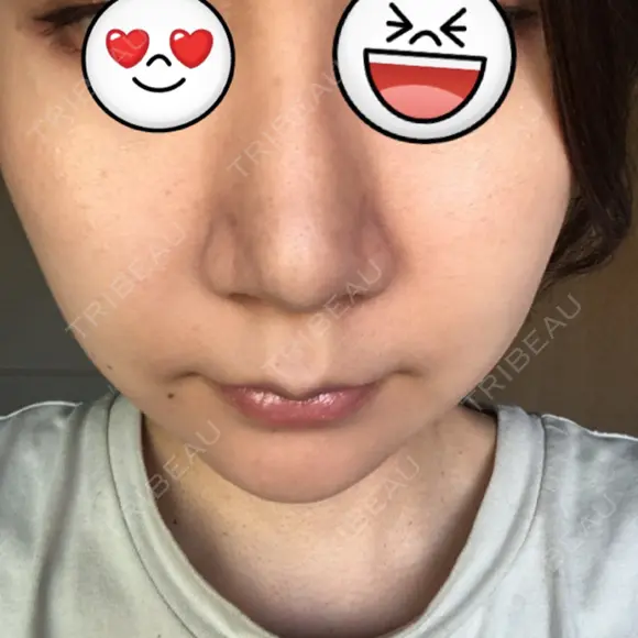 鼻尖形成（切開） / ヒアルロン酸注入（鼻） 東京ヒルズクリニック 新宿院 DAY 38 メイン用