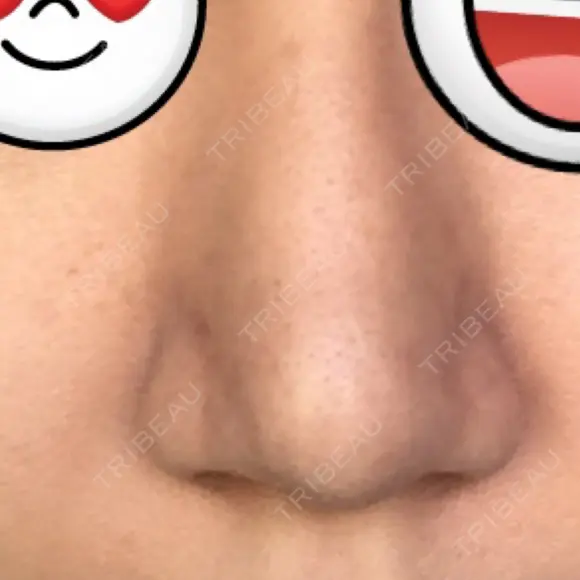 鼻尖形成（切開） / ヒアルロン酸注入（鼻） 東京ヒルズクリニック 新宿院 DAY 38 メイン用