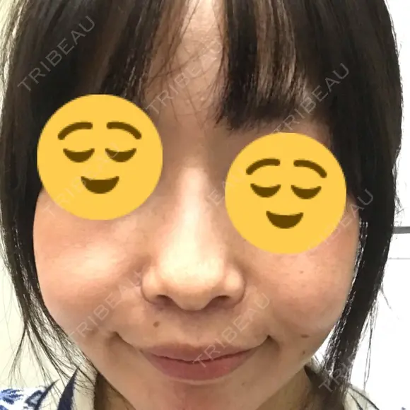 小鼻縮小（切開） / その他（鼻） 湘南メディカル記念病院（両国） DAY 34 メイン用