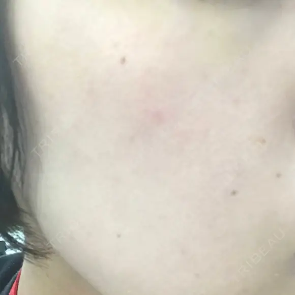 ピーリング（ニキビ・毛穴） 自由が丘クリニック DAY 2 メイン用