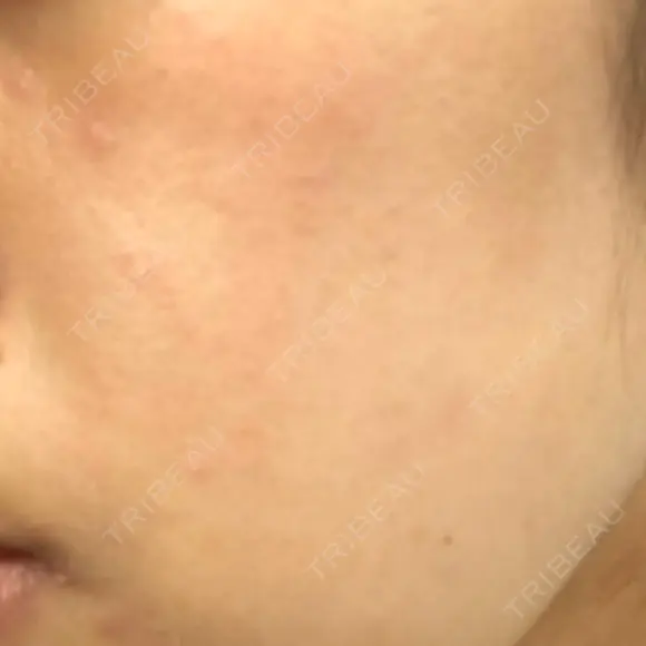 ピーリング（ニキビ・毛穴） 自由が丘クリニック DAY 10 メイン用