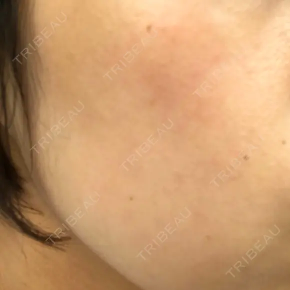 ピーリング（ニキビ・毛穴） 自由が丘クリニック DAY 10 メイン用