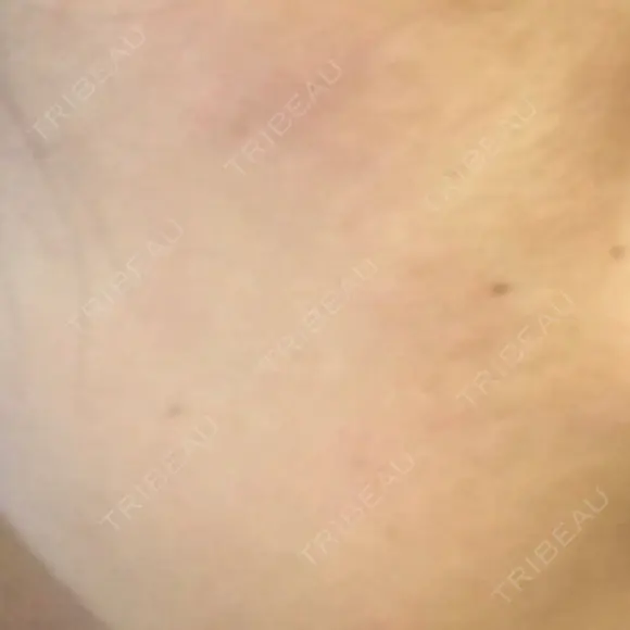 ピーリング（ニキビ・毛穴） 自由が丘クリニック AFTER メイン用