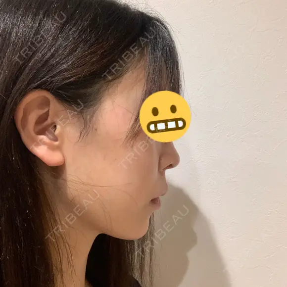 ヒアルロン酸注入（あご） 植村美容外科 AFTER メイン用