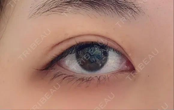 二重埋没 湘南美容クリニック 藤沢院 DAY 46 メイン用