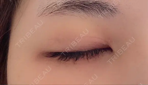 二重埋没 湘南美容クリニック 藤沢院 DAY 46 メイン用