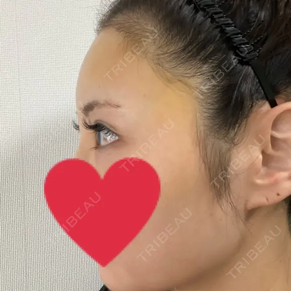 額を丸く / こめかみ形成 閉院｜プルージュ美容クリニック 赤羽院 DAY 6 メイン用