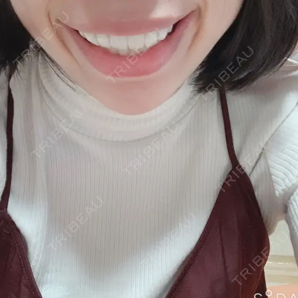 ガミースマイル手術 / 矯正（ワイヤー） / セラミック / ホワイトニング ラ・ブージュデンタルクリニック DAY 84 メイン用