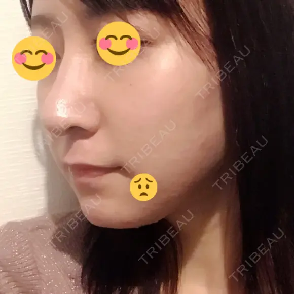隆鼻術 / 鼻尖形成（切開） / 軟骨移植 / 鼻修正 湘南美容クリニック 柏院 DAY 380 メイン用