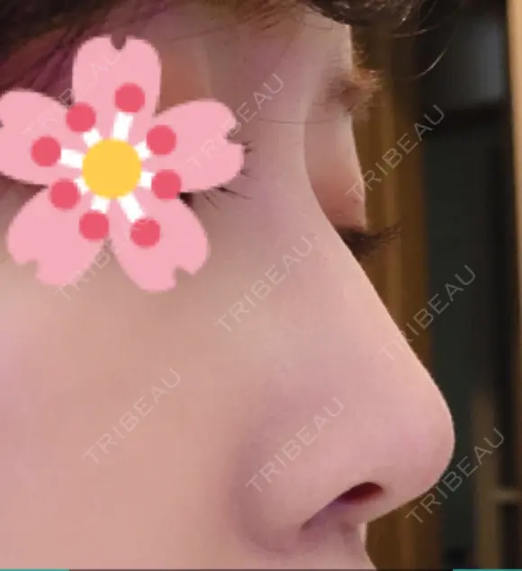 鼻尖形成（切開） / ヒアルロン酸注入（鼻） 東京ヒルズクリニック 新宿院 DAY 16 メイン用