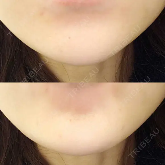 ボトックス（あご） 品川美容外科 仙台院 DAY 4 メイン用