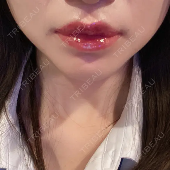 口唇縮小術 くさのたろうクリニック DAY 14 メイン用