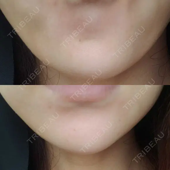 ボトックス（あご） 品川美容外科 仙台院 DAY 6 メイン用