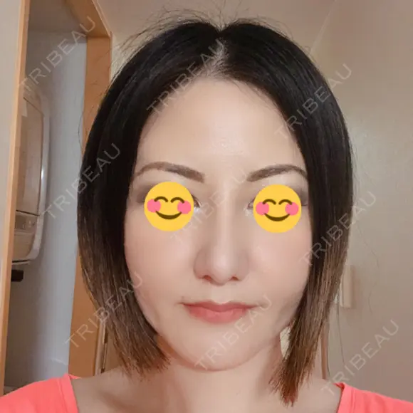 隆鼻術 / 鼻尖形成（切開） / 小鼻縮小（切開） / 軟骨移植 湘南美容クリニック 那覇院 AFTER メイン用