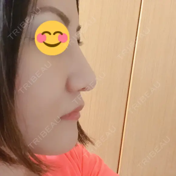 隆鼻術 / 鼻尖形成（切開） / 小鼻縮小（切開） / 軟骨移植 湘南美容クリニック 那覇院 DAY 110 メイン用