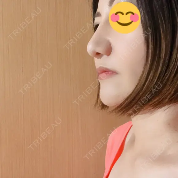 隆鼻術 / 鼻尖形成（切開） / 小鼻縮小（切開） / 軟骨移植 湘南美容クリニック 那覇院 DAY 110 メイン用