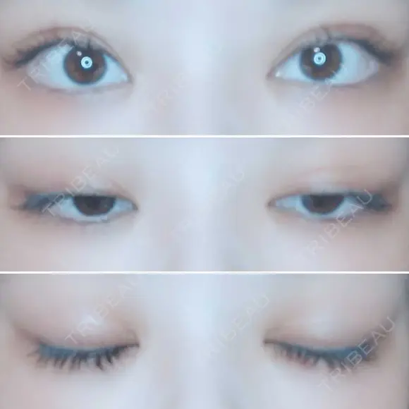 二重切開 / 目頭切開 / 上まぶたたるみ取り 湘南美容クリニック 金沢院 AFTER メイン用