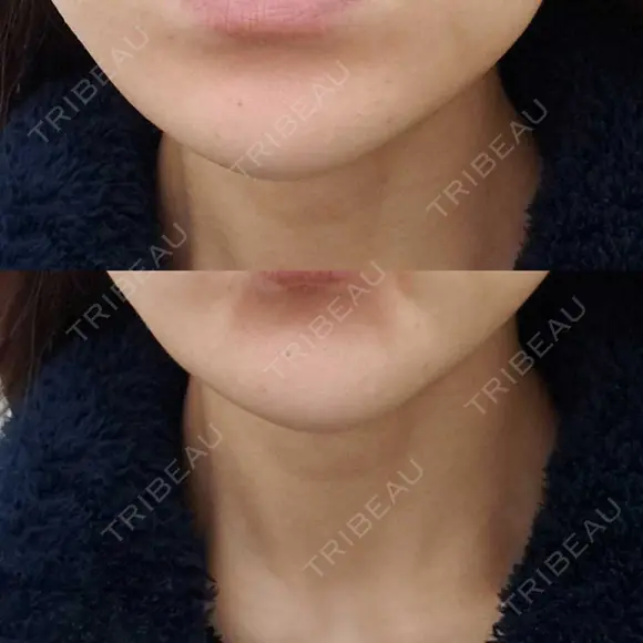 ボトックス（あご） 品川美容外科 仙台院 DAY 9 メイン用