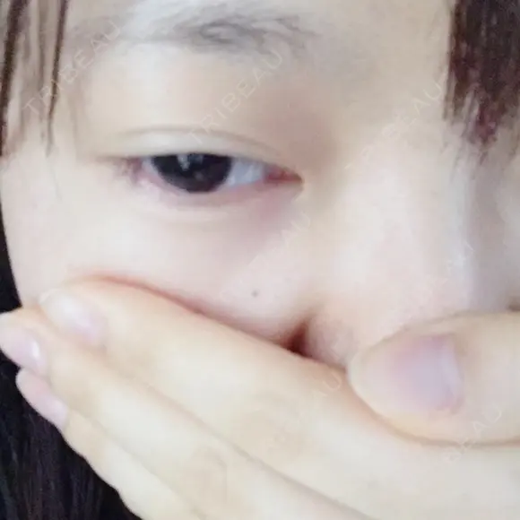 二重埋没 かわた美容クリニック DAY 192 メイン用