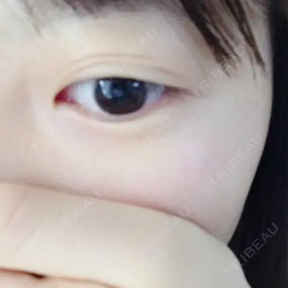 二重埋没 かわた美容クリニック DAY 192 メイン用