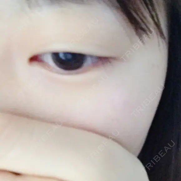 二重埋没 かわた美容クリニック DAY 192 メイン用