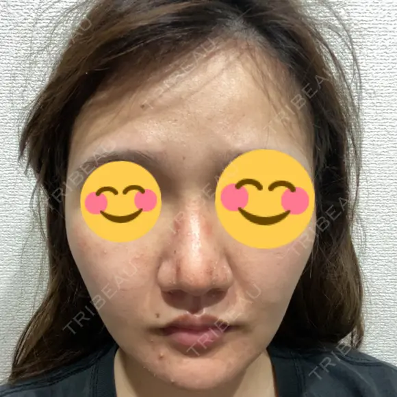 ピーリング（ニキビ・毛穴） / ダーマペン 品川美容外科 静岡院 DAY 2 メイン用