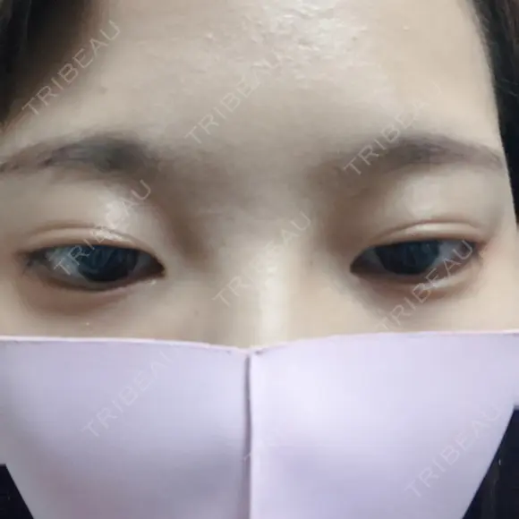 二重埋没 かわた美容クリニック DAY 197 メイン用
