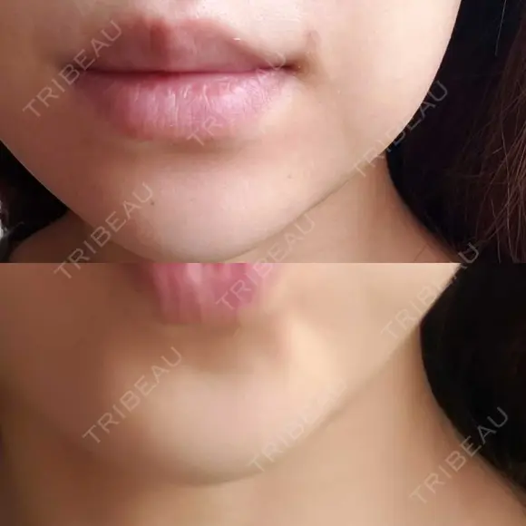 ボトックス（あご） 品川美容外科 仙台院 DAY 13 メイン用