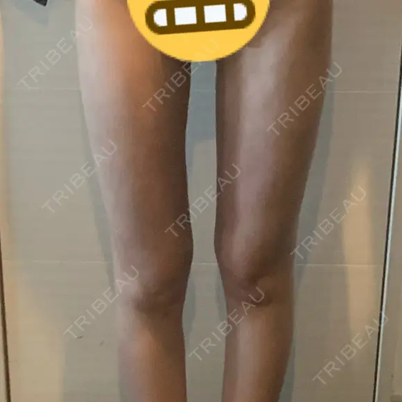 脂肪吸引（脚） / 豊胸（脂肪注入） / 脂肪注入（額） 湘南美容クリニック 新橋銀座口院 DAY 25 メイン用