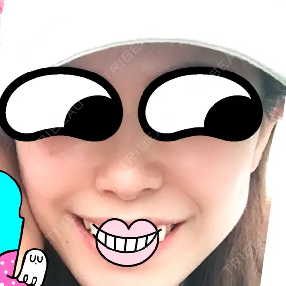 鼻尖形成（切開） / 小鼻縮小（切開） / 軟骨移植 湘南美容クリニック 船橋院 AFTER メイン用