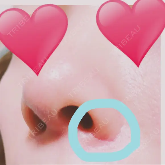 鼻尖形成（切開） / 小鼻縮小（切開） / 軟骨移植 湘南美容クリニック 船橋院 DAY 61 メイン用