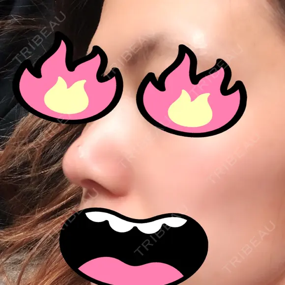 鼻尖形成（切開） / 小鼻縮小（切開） / 軟骨移植 湘南美容クリニック 船橋院 DAY 61 メイン用