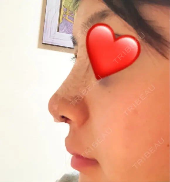 隆鼻術 / 鼻尖形成（切開） / 鼻中隔延長（切開） / 軟骨移植 グロービー美容整形外科 DAY 4 メイン用