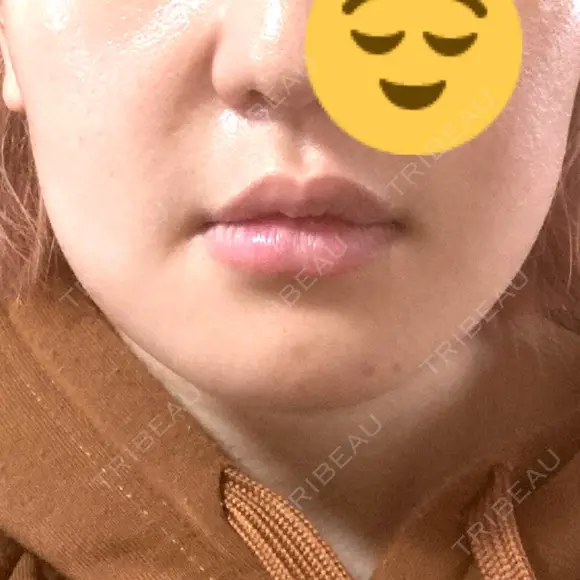バッカルファット除去 / セットバック 銀座フェイスクリニック（小顔整形・輪郭整形專門） DAY 14 メイン用