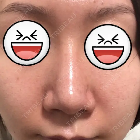 鼻尖形成（切開） / ヒアルロン酸注入（鼻） 東京ヒルズクリニック 新宿院 DAY 57 メイン用