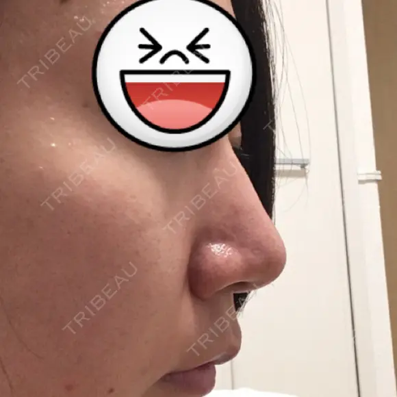 鼻尖形成（切開） / ヒアルロン酸注入（鼻） 東京ヒルズクリニック 新宿院 DAY 57 メイン用