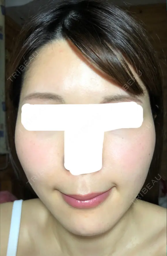 糸リフト / バッカルファット除去 / 脂肪吸引（顔） / ボトックス（エラ・小顔） 湘南美容クリニック 秋葉原院 DAY 85 メイン用