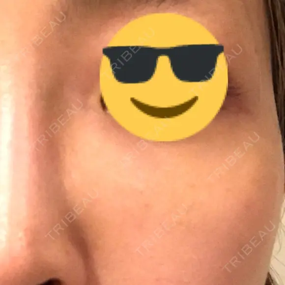 シミ取りレーザー / 美白レーザー / YAGレーザー / その他（目元） YAG BEAUTY CLINIC TOKYO  DAY 5 メイン用