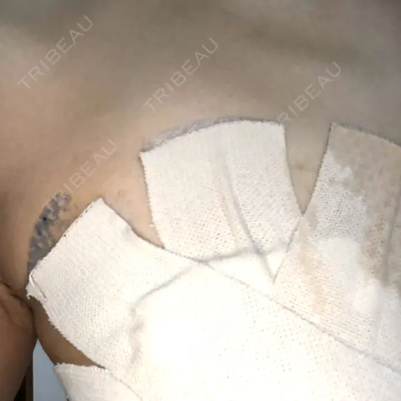 その他（胸） 三輪皮フ科形成外科 DAY 2 メイン用