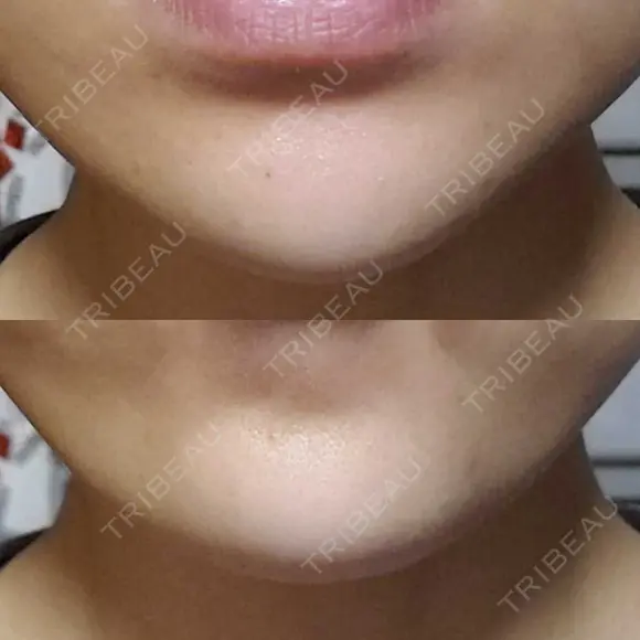 ボトックス（あご） 品川美容外科 仙台院 AFTER メイン用