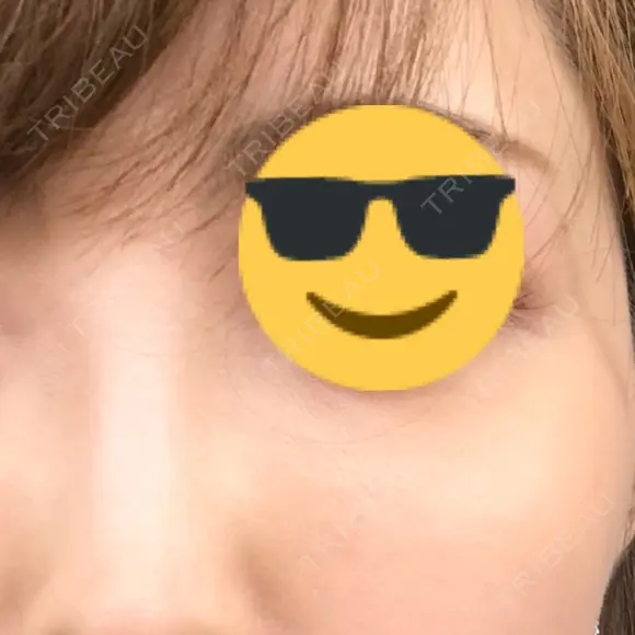 シミ取りレーザー / 美白レーザー / YAGレーザー / その他（目元） YAG BEAUTY CLINIC TOKYO  AFTER メイン用