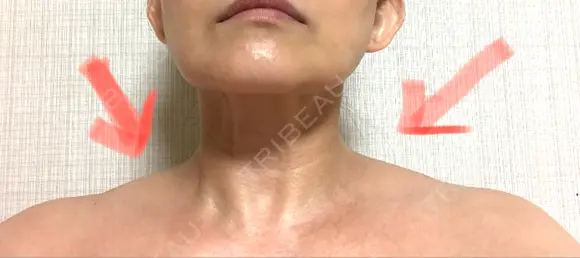 ボトックス（肩） 湘南美容クリニック 奈良院 DAY 5 メイン用