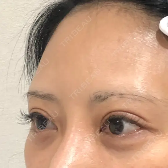 二重切開 BIANCA銀座 DAY 89 メイン用