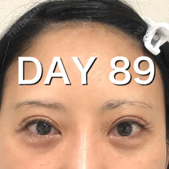 二重切開 BIANCA銀座 DAY 89 メイン用