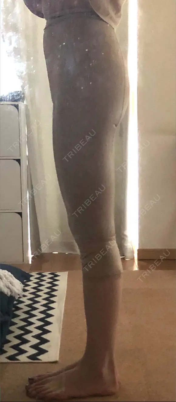 脂肪吸引（脚） ドクターフィット（Dr.fit）クリニック DAY 41 メイン用