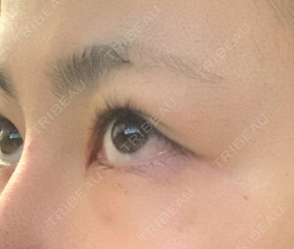目頭切開 アロマ美容外科クリニック DAY 29 メイン用