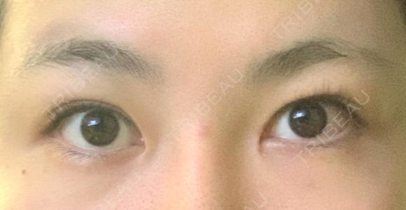 目頭切開 アロマ美容外科クリニック DAY 29 メイン用