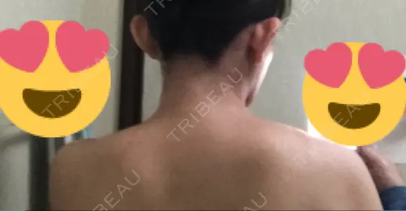 ボトックス（肩） 湘南美容クリニック 奈良院 DAY 9 メイン用